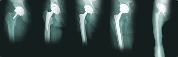 hip replacement options for arthrosis