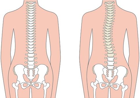 Lower back pain due to spinal deformities such as scoliosis