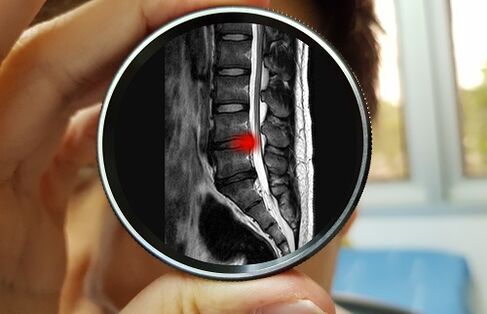 The consequence of ignoring pain in the lower back can be a herniated disc. 