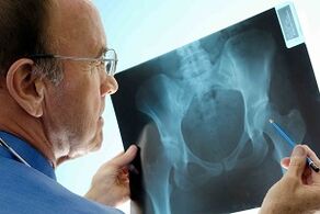 Arthrosis of hip joint on x -ray