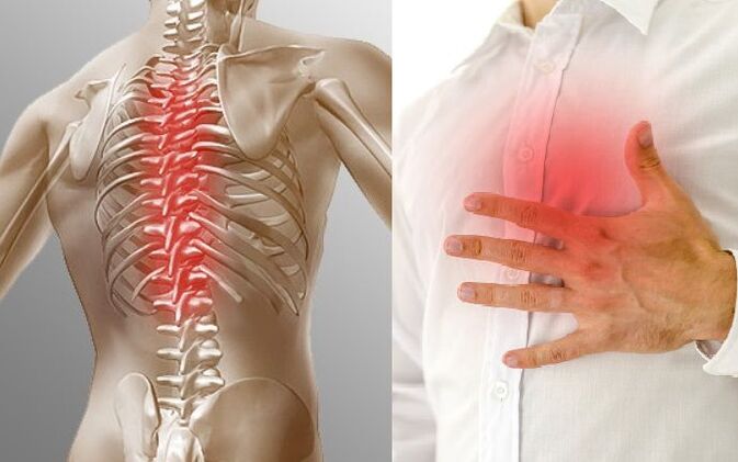 Thoracal osteochondrosis and chest pain