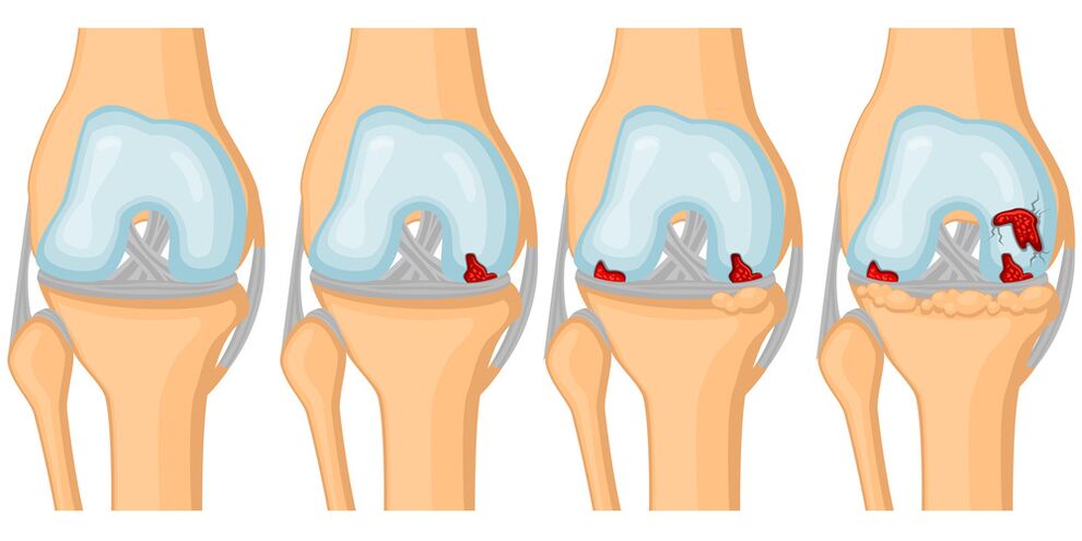 The degree of development of joint arthrosis